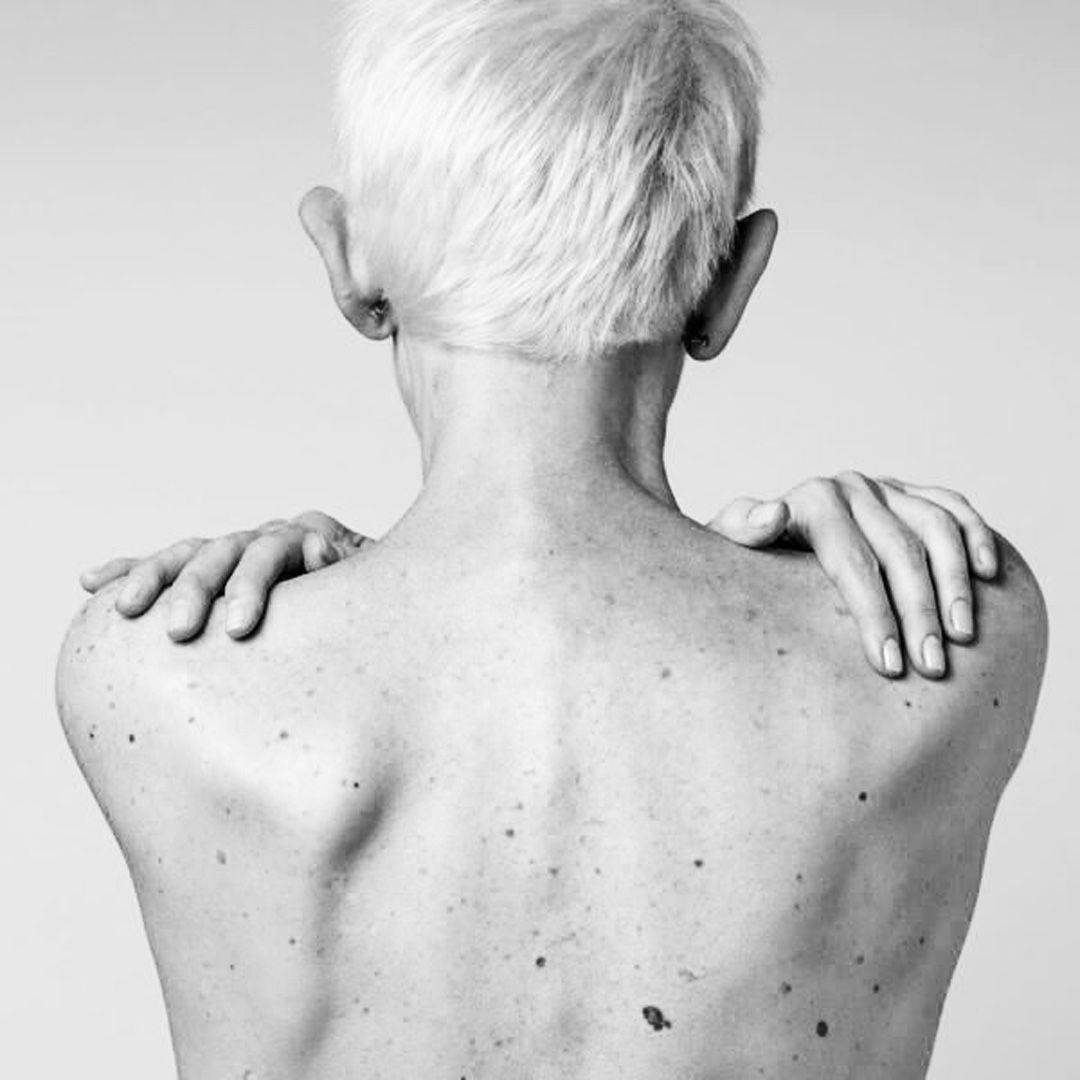 Spot Check: What’s the Difference Between Freckles, Sunspots and Moles ...